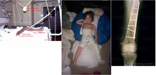 Predisposition in Children